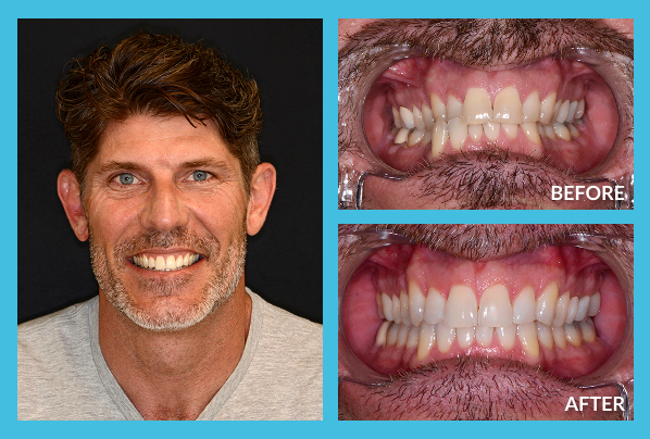 Invisalign