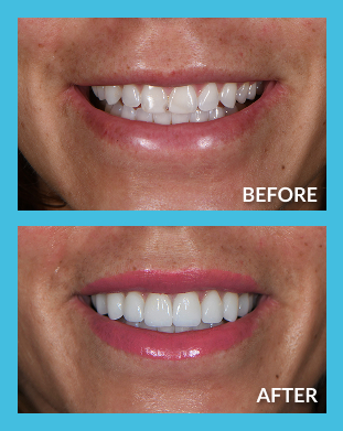 porcelain-veneers