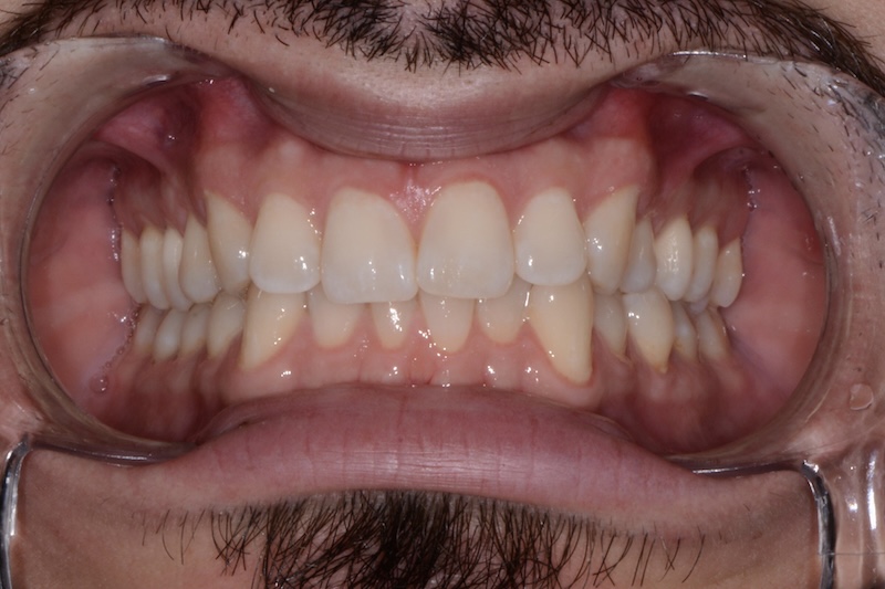 Before